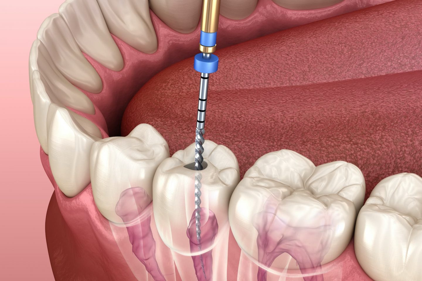 Root-Canal-Treatment (1)