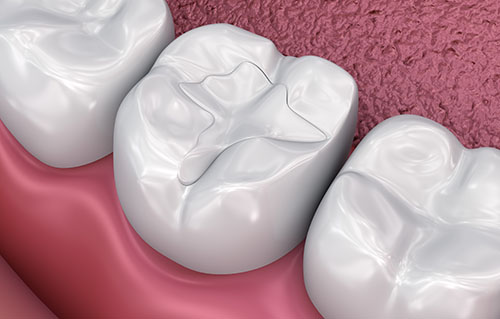dental-fillings-and-sealants-missouri-city-tx (1)
